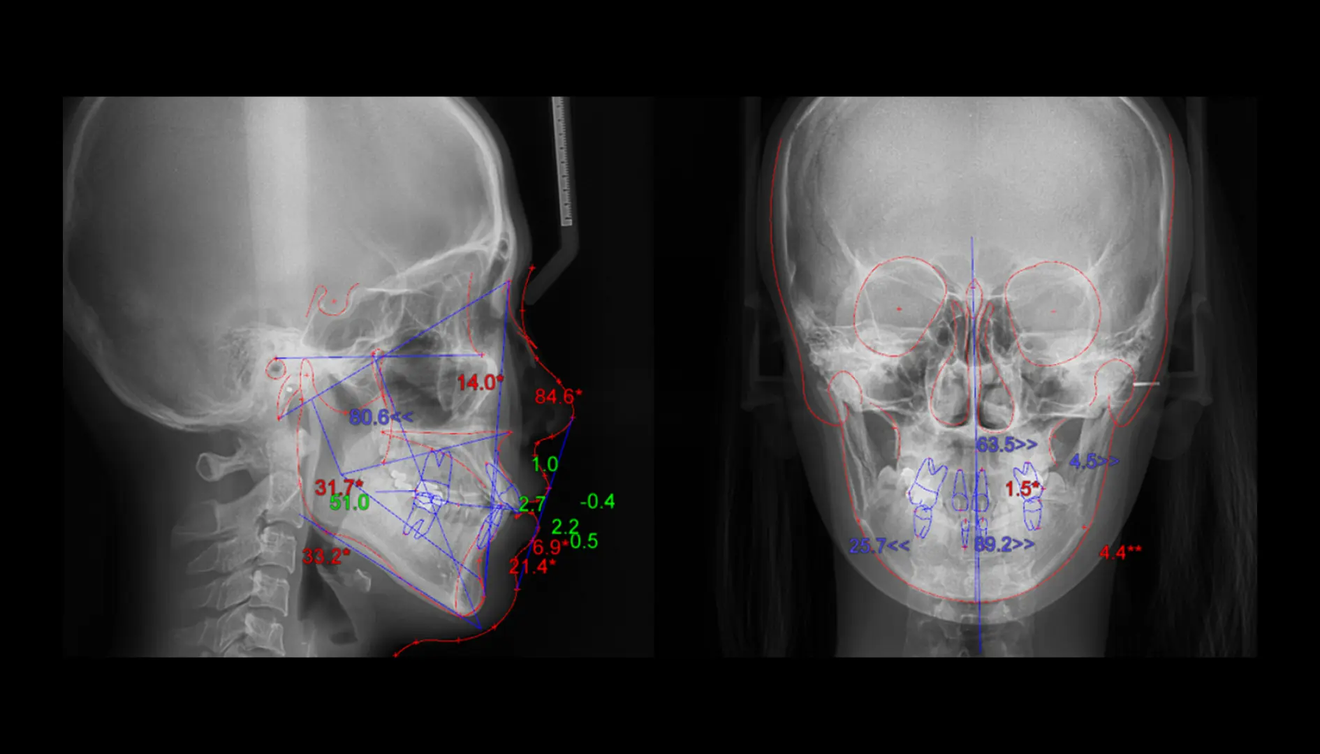 디지털 분석 (측면 & 정면)