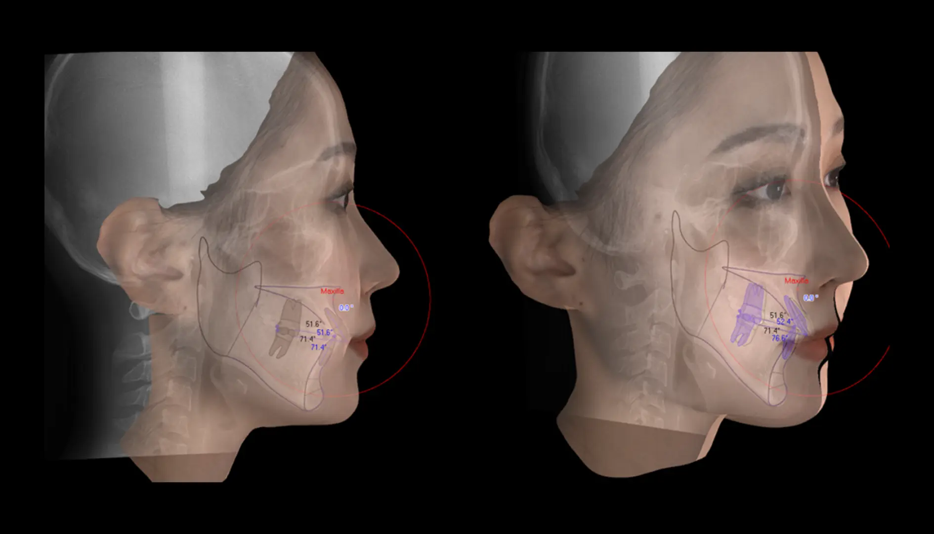 시수술 (측면 & 정면)